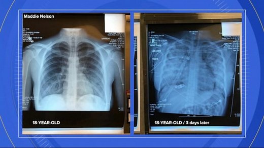 Is vaping marijuana making people ill?