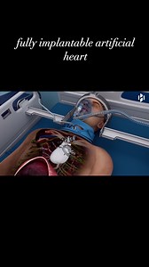 Medical insightX😷 on Instagram: "A fully implantable artificial heart is a mechanical device designed to completely replace a diseased or failing human heart, allowing patients to live without external pumps or wires. These devices, like the AbioCor and Carmat, are implanted internally and powered by internal batteries or transcutaneous energy transfer, offering greater mobility compared to earlier artificial hearts. Key Features of Fully Implantable Artificial Hearts: Complete Heart Replacemen