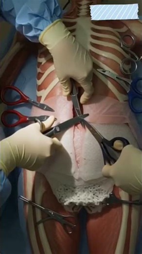 C section delivery#baby #delivery #modernfertility #pregnant #animation #viral