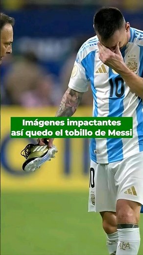 BRUTAL! This is how Lionel Messi's ankle looked after his injury in the 2024 Copa América final.