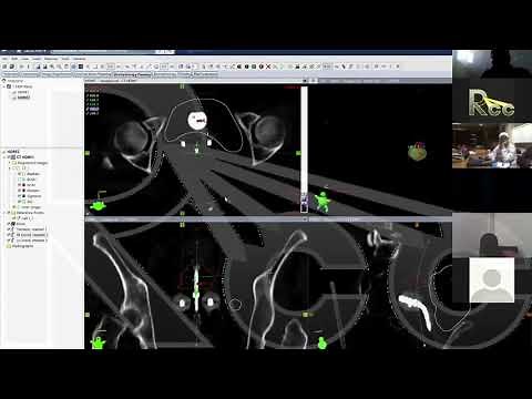 Rayos Contra Cancer HDR Brachytherapy Live Planning 1: T&O, T&Ring | Derek Brown, Dan Scanderbeg