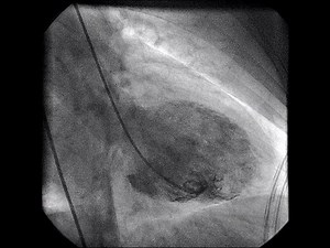 Four types of takotsubo (stress) cardiomyopathy — apical, midventricular, basal, and focal — are shown in videos of left ventricular angiography. http://nej.md/1JBBjR1 | The New England Journal of Medicine