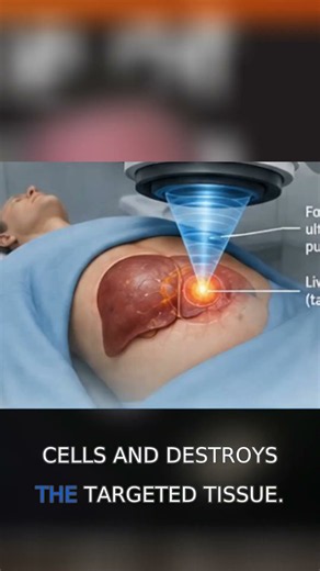 How histotripsy destroys tumors without cutting