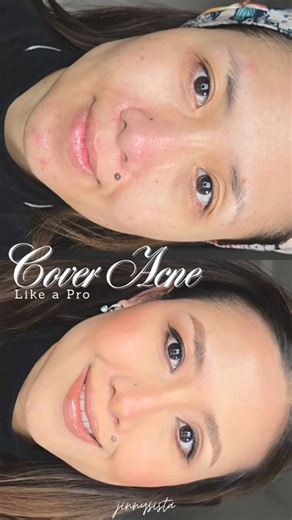 How to cover acne like a pro #makeuptutorial