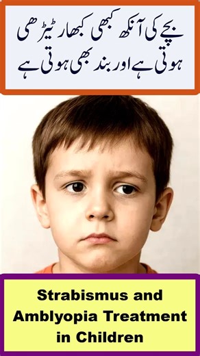 Strabismus and Amblyopia Treatment in Children