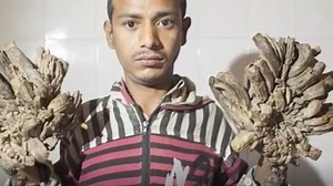 Bangladesh man suffering from tree man syndrome needs more surgeries