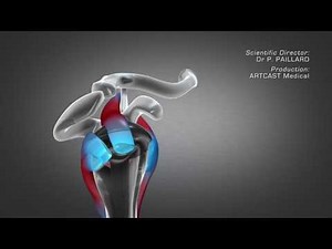 Standard or reverse shoulder replacement
