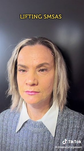 LIFTING SMAS #harmonizacaofacial#hpradicalreuse