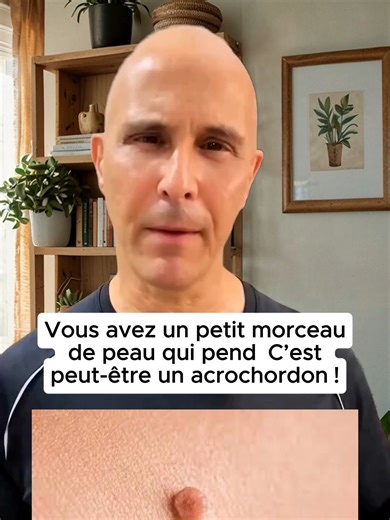Vous avez un petit morceau de peau qui pend C’est peut-être un acrochordon !#conseilsdesanté#sante #santé #santénaturelle #fraces