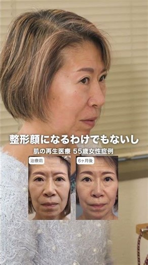 Cosmetic surgery that doesn't result in a surgically altered face