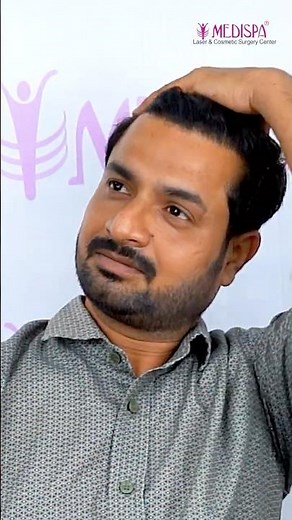 2500 Grafts Hair Transplant Results | BIO-Enhanced Direct Implant Technique | Natural Hairline