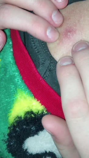 Pimple popper on TikTok