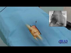 Genicular nerve block