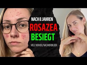 Conquering Rosacea: My Skin Journey After 8 Years | Before/After & Experiences | LALALUNIA