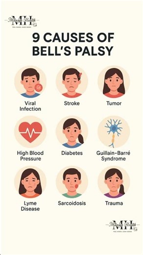 Causes of bell's palsy
