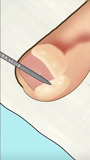 ASMR Infected Finger#animation #cleaning #satisfying #foryou #shortsasmr #asmr #asmrsounds