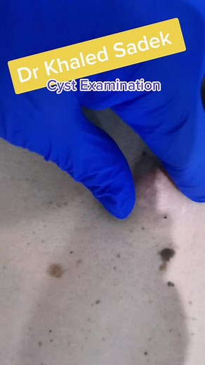 Cyst Removal examination #cystremoval #blackheads #pimples #pimplepopper #skincare #acne #drkhaledsadek #blackheadremoval
