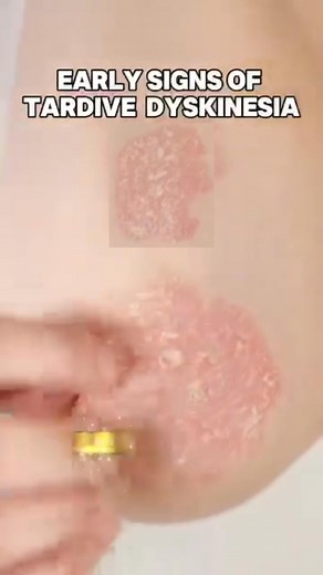 What to Know About Care Options for Tardive Dyskinesia! | Health is your choice