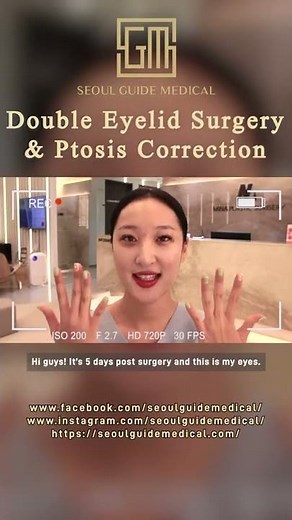 Double Eyelid & Ptosis Correction | Seoul Guide Medical