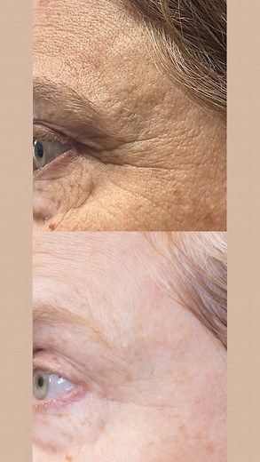 13 reactions | Instant glow, no downtime, no needles - the CO2 Lift...