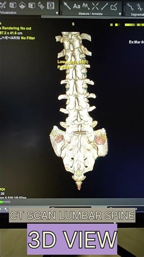 CT SCAN LUMBAR SPINE #ctscan #ctscanner #spine #lumbarspine #fracture #trendingshorts #viralvideo