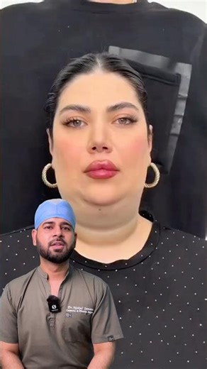 Neck liposuction: what is the reality?by Dr. Nakul Somani (cosmetic & plastic surgeon)|8290000117