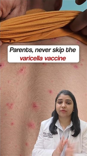 Chicken Pox Choti Mata in kids| Varicella vaccine in children #vaccine #immunization #kids #shorts