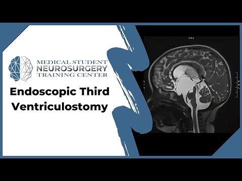 Endoscopic Third Ventriculostomy