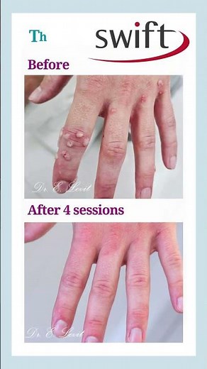 Goodbye, Warts — Hello, Clear Skin!