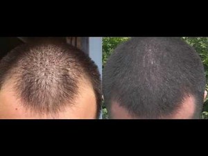 1 year minoxidil hair regrowth results, before and after. 2013!