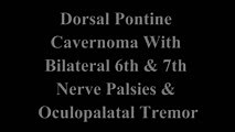 Pontine Hemorrhage Causing Oculopalatal Tremor and Multiple Cranial Neuropathies | NOVEL - Daniel Gold Collection