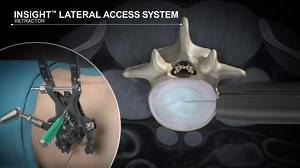 Spine | DePuy Synthes