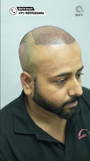 Amazing Hair Transplant Surgery | Latest Fue Technique #shorts #viral #hair transplant