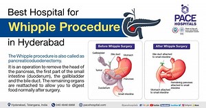 Best Hospital for Whipple Procedure in Hyderabad | Surgery and Cost