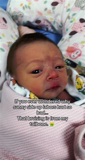 Soooo painful 😅🤮 the post should say PUBIC BONE not tail bone. 😭🤦‍♀️ my bad #sunnysideup