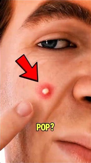 Pimple Mistakes That Could Leave You Scarred