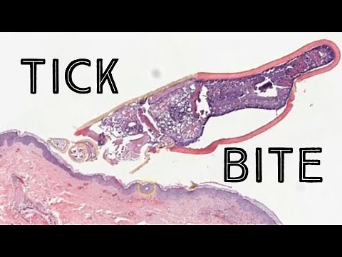 Tick bite close up under microscope (tick embedded in skin with vasculitis) pathology dermpath