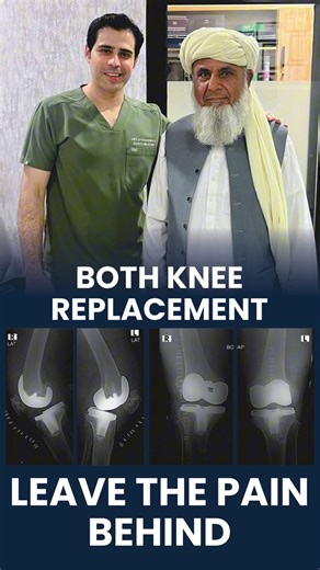 From Severe Knee Pain to Pain-Free Walking 🙌 Both Knee Replacement Surgery done successfully. Today, the patient is walking without pain and smiling again. This is not just surgery — ✨ It’s freedom from pain ✨ It’s independence ✨ It’s a better life Trust experience. Trust care. 📞 Appointment: 041-8521009 | 0300-0134146 #KneeReplacement #BothKneeReplacement #TotalKneeReplacement #PainFreeWalking #KneeSurgerySuccess #OrthopedicSurgeon #OrthopedicCare #AdvancedKneeCare #KneePainRelief #JointRepla