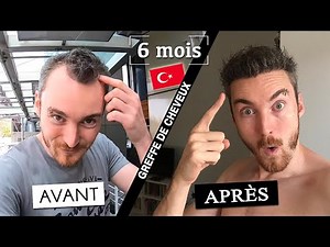 [Greffe de cheveux AVANT / APRÈS] Mes résultats après 6 mois ! 🇹🇷