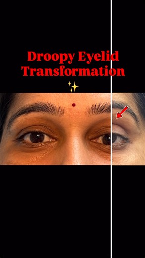 Dr. Pallavi Singh on Instagram: "👁️MMCR (Müller’s Muscle-Conjunctival Resection) surgery is a minimally invasive procedure to treat mild drooping of the upper eyelid (ptosis). It involves tightening a small muscle inside the eyelid to lift it, improving vision and appearance. This quick surgery usually requires no external incisions and offers a faster recovery time. ↔️This is the 6 week #beforeandafter of my beautiful patient who underwent left #ptosis surgery. There is still mild swelling whi