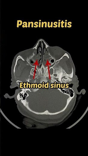 Pansinusitis para nasal sinuses | CT scan | Radiology #ctscan #sinusitis #pns
