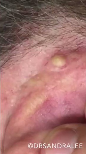 VERY nice and easy... ✌️❤️💥 #drpimplepopper #popaholics