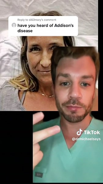 Understanding Addison's Disease: A Deep Dive into This Chronic Illness