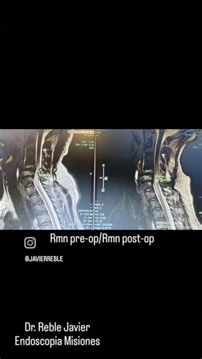​Endoscopia de Columna: Cómo liberar tu médula con solo 1 cm.