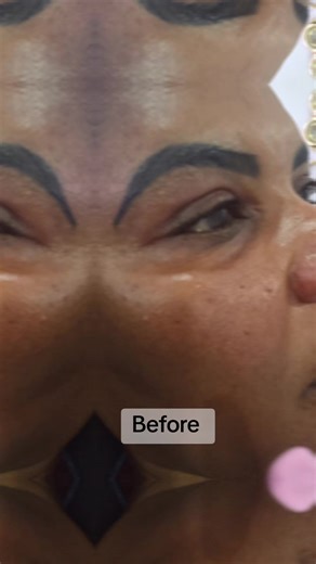 Revitalize Your Look with DrMinx Under-Eye Filler