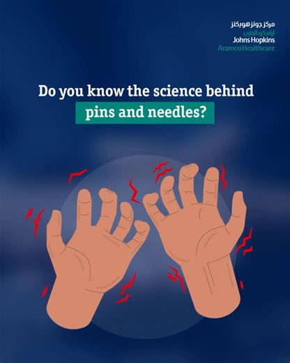 Ever wondered why “pins and needles” happens? That tingling sensation is your nervous system recovering after temporary pressure reduces blood flow to a limb. Once circulation returns, sensory nerves begin firing again — sometimes all at once — creating the prickling feeling you notice. In most cases, it’s harmless and fades within minutes. However, if numbness or tingling occurs without pressure or persists, it’s best to seek medical advice. | Johns Hopkins Aramco Healthcare