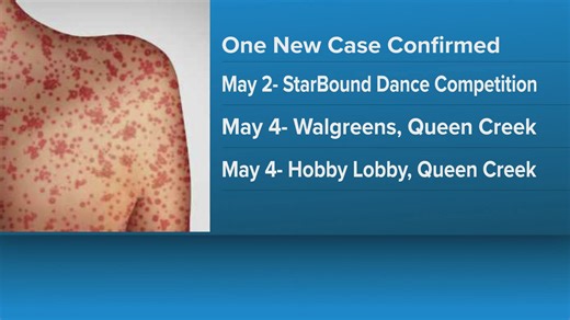 New measles case confirmed in Maricopa County