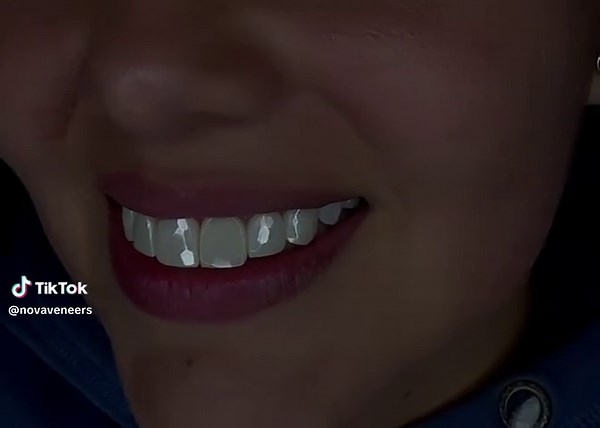 💎✨ Another stunning transformation at NovaStudio From natural to next-level brilliance — our patient now shines with diamond-cut veneers. Every facet was designed to reflect light like a fine gem. The result? A smile that turns heads and tells a story of elegance. Because this isn’t just cosmetic dentistry — it’s smile artistry. 💬 What do you think of this glow-up? Drop a ✨ in the comments! — #DiamondVeneers #SmileTransformation #LuxurySmile #CrystalSmile #FacetedVeneers #ZirconiaVeneers #Holl