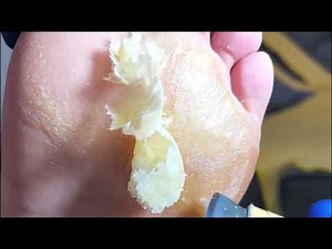 The Hidden Reasons Behind Stubborn Foot Calluses