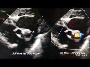 suprasternal view - PDA on 2D and color Doppler Echocardiography